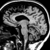 Sagittal T1WI MR demonstrates marked atrophy of the frontal lobe in a patient with FTD.