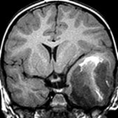 Coronal T1WI MR shows marked expansion of the left temporal lobe by a hemorrhagic mass  .