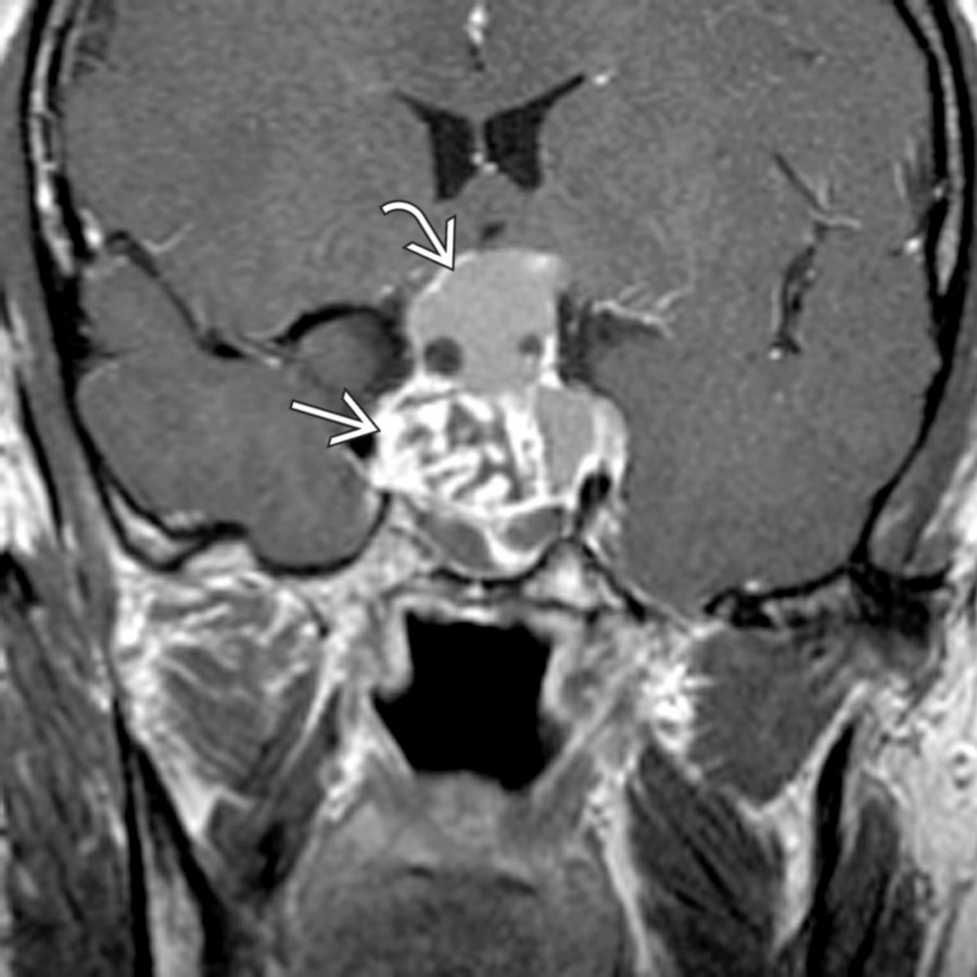 Coronal T1 C+ MR in a child shows a intra-/suprasellar mass. An apical nonenhancing portion is surrounded by a thin enhancing rim . The solid portion enhances strongly but heterogeneously .