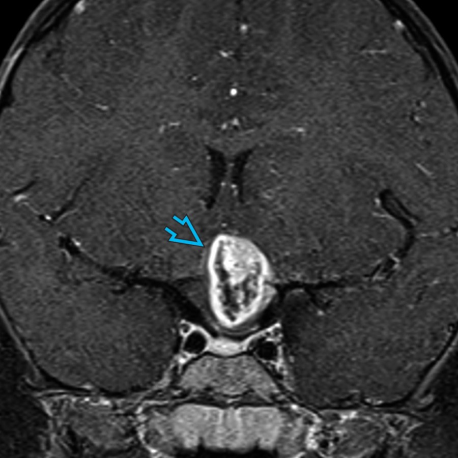 Coronal T1 C+ FS MR shows a heterogeneously enhancing suprasellar mass  in a child that was found to represent a pilomyxoid astrocytoma, WHO grade 1. Pilomyxoid astrocytoma is a subtype of pilocytic astrocytoma that is often more aggressive.