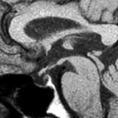 Sagittal T1 MR demonstrates a thinned pituitary gland  along the floor of the mostly empty sella in a 34-year-old woman who had postpartum anterior pituitary gland necrosis (Sheehan syndrome) 10 years prior to imaging.