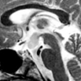 Sagittal T2WI MR demonstrates that the lesion  is slightly bright.