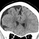 Coronal NECT MPR through the frontal lobes of a 62-year-old man with behavioral variant frontotemporal dementia (bvFTD) shows asymmetric atrophy of right frontal lobe  with relatively preserved left frontal lobe volume .