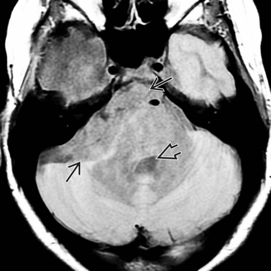 Axial PD MR in the same patient shows a lobulated mass  in the right CPA cistern that is nearly isointense with CSF in the cistern and 4th ventricle .