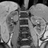 Coronal out-of-phase T1 MR shows marked signal suppression of the left adrenal lesion, confirming a clinically functional, imaging apparent, lipid-rich adenoma . Signal suppression is due to intravoxel cytoplasmic lipid and water. Aldosterone-secreting adenomas are typically small (< 2 cm).