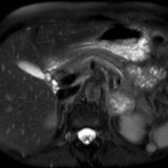 Axial T2 FS MR in the same patient shows low signal at the periphery of the mass  and increased signal centrally. Central degeneration, hemorrhage, and fibrosis are known features of some adrenal adenomas. The mass demonstrated diffuse signal loss on out-of-phase MR, consistent with intracellular lipid and adenoma.