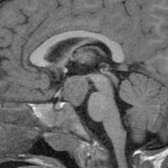 Sagittal T1WI MR in a 2-year-old girl with precocious puberty shows a large, pedunculated "collar button" hypothalamic hamartoma (HH) . The lesion is in the classic location between the infundibular stalk  anteriorly and the mammillary bodies posteriorly.