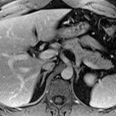 Axial T1 C+ MR at a slightly more caudal level now brings into view the twin limbs of each of the 2 adrenal glands. Each limb is thin and regular (without thickening or a nodule). Note that the right adrenal gland contacts the posterior margin of the IVC and is medial to the right diaphragmatic crus. The left adrenal gland is located slightly ventral and above the left kidney.