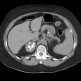 Axial NECT in a 71-year-old woman shows a 4-cm, complex cystic right adrenal mass  containing coarse calcifications. Adrenalectomy (performed given lesion complexity and size) confirmed hemorrhagic pseudocyst.
