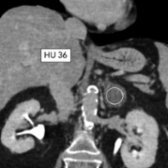 Coronal 15-minute delayed-phase CECT shows washout of the left adrenal mass (HU 36) with relative washout of 51%, highly suggestive of an adrenal adenoma . Biochemical work-up, including metanephrines, performed due to the size of the mass was normal.
