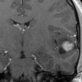 Coronal T1 C+ MR in a young adult patient with epilepsy shows a cystic and solid mass in the temporal lobe with intense enhancement of the solid mural nodule . Gangliogliomas are the most common tumor to cause temporal lobe epilepsy.