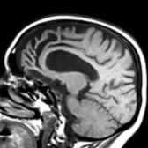 Sagittal T1WI MR shows predominantly frontal & temporal lobe atrophy. Some gyri demonstrate a classic knife-like appearance () reflecting severe atrophy of a gyrus.