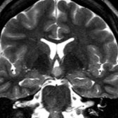 Coronal T2WI MR in the same patient shows the mass  remains isointense with gray matter and elevates, but does not obstruct, the 3rd ventricle.