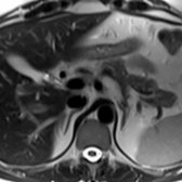 Axial T2 HASTE MR demonstrates a normal appearance of the adrenal glands on these images acquired without fat saturation. The adrenal glands in this image appear relatively isointense to the liver (although the relative signal can vary depending on application of fat saturation).
