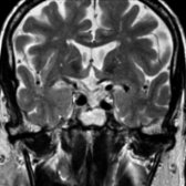 Coronal T2 MR of a secondary ES in the same patient demonstrates that the sella is filled with CSF . Note the thinned optic chiasm  retracted downward toward the sella.