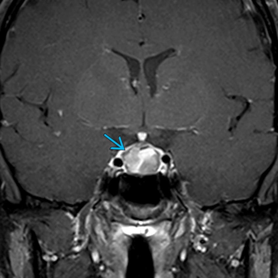 Coronal T1 C+ MR shows an enlarged pituitary gland  with a heterogeneous macroadenoma. Pituitary apoplexy can be considered in patients with acute clinical features, including headache, visual defects &/or altered mental status, and a heterogeneous pituitary mass.