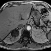 Axial out-of-phase T1 MR in the same patient shows marked signal loss in the adrenal mass , indicating intracytoplasmic lipid and consistent with adrenal adenoma.