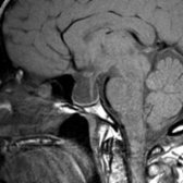 Sagittal T1 MR shows a 40-year-old man with an incidentally found partially ES. No endocrine laboratory abnormalities were reported. Notice the enlarged, bony sella with thin rim of pituitary tissue .