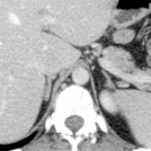 First of 3 CT images of a subject with normal adrenal glands shows conventional anatomy.