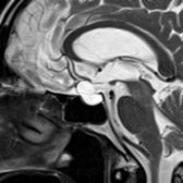 Sagittal T2 MR in the same patient shows the lack of CSF flow artifact within the cyst  compared to the flow within the suprasellar and interpeduncular cisterns .