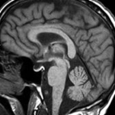 Sagittal T1 MR shows an incidental finding of a partially ES  .