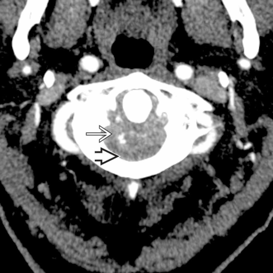 CTA study shows multiple punctate foci of calcification within a large soft tissue mass posterior to the odontoid process  that causes cord compression . No gross erosive changes are present within the odontoid process, as would be present in RA.