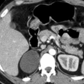 Axial CECT shows a nonenhancing water density right adrenal cyst.