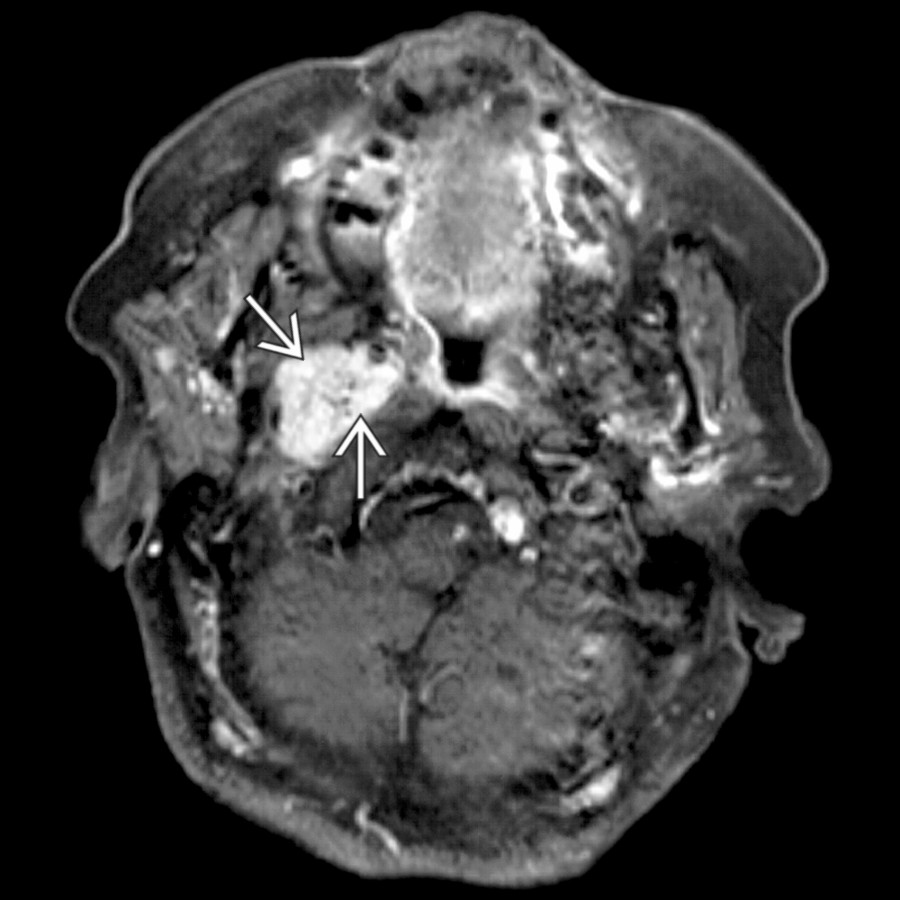 Axial T1 C+ FS MR shows the typical imaging appearance of a glomus tumor (vagale paraganglioma): A soft tissue mass  below the skull base with small, focal signal voids indicating the presence of high-flow vessels.