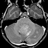 Axial T1 C+ MR shows a heterogeneously enhancing mass in the 4th ventricle . Adjacent nodules of enhancement are seen in the cerebellar hemisphere from leptomeningeal metastases . WNT medulloblastomas have a > 90% survival rate despite metastatic disease.