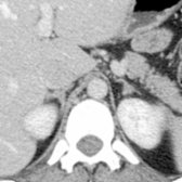 More caudal section shows both adrenal glands with an inverted Y appearance. There is mild thickening of the left adrenal gland at the confluence of the medial and lateral limbs, a normal finding.