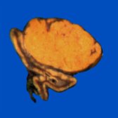 Adrenal vein sampling was subsequently performed, which confirmed an aldosterone-secreting left adrenal lesion. Gross photo of the laparoscopically resected left adrenal gland shows an exophytic, well-circumscribed adrenocortical adenoma .