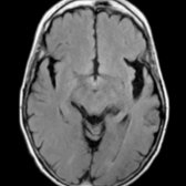 Axial FLAIR MR in the same patient shows asymmetric atrophy of bilateral temporal lobes (left > right) with knife-like gyri . (Courtesy M. Matesan, MD.)