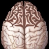 Graphic depicts the classic disproportionate frontal lobe atrophy of late-stage frontotemporal dementia (FTD). The sulci are widened & gyri are knife-like . Parietooccipital lobes are spared. Gyri around the central sulcus are normal.