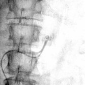 A subsequent image shows the catheter repositioned. The tip has been advanced through the left renal vein to enter the left adrenal vein. No attempt is made to opacify the smaller venous tributaries.