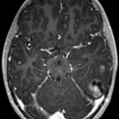 Axial T1 C+ MR shows an enhancing mass in the posterior temporal lobe  with a satellite nodule . This was a diffuse, high-grade glioma with H3 K27 mutation at resection.