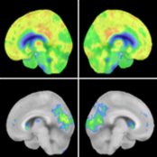 Right & left medial sagittal FDG PET source & 3DSSP images of a 74-year-old man with dementia with Lewy bodies (DLB) presenting with visual hallucinations show severe ↓ metabolic activity in left visual cortex  & precuneus . Note moderate ↓ metabolic activity in right occipital lobe  & precuneus  & relative sparing of bilateral posterior cingulate gyri .
