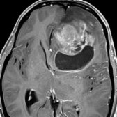 Axial T1 C+ FS MR shows an infiltrative left frontal lobe glioblastoma with cystic  and heterogeneously enhancing, solid, nodular  components. Glioblastomas have a predilection for crossing midline through the corpus callosum.