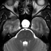 Axial T2 MR in the same patient shows the bony sella is expanded and filled with CSF  . A normal pituitary infundibulum  is present in the midline.