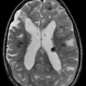 Axial T2 MR shows a severe burden of hyperintense cortical dysplastic lesions (i.e., tubers) , some of which display associated dark areas of mineralization . Also note the calcified subependymal nodule  along the left lateral ventricle margin.