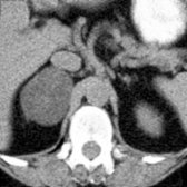 Axial NECT shows a homogeneous, low-density adenoma that is larger than typical, which had grown slowly over 10 years.