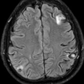 Axial FLAIR MR demonstrates a neurocysticercosis cyst  with an eccentric nodule (scolex) . Additional lesions have surrounding edema . Edema and enhancement vary with the stage of neurocysticercosis and host response.