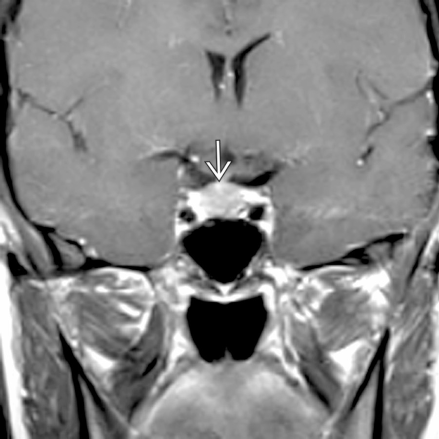 Coronal T1 C+ MR shows a physiologically enlarged pituitary gland  in this 28-year-old lactating woman. The gland measures nearly 12 mm in height. Follow-up scan 1 year later was normal.