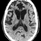 Axial NECT demonstrates predominantly frontal lobe volume loss from FTD.