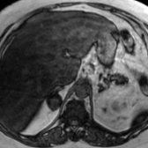 Axial out-of-phase T1 MR shows signal dropout at the periphery of the mass  and in the liver , indicating intracellular lipid. The mass was resected based on indeterminate imaging features and shown to be an adenoma with central degeneration, which can be seen with adenomas and can be confused with a collision tumor.