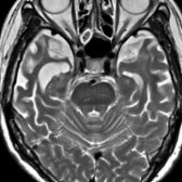 Axial T2WI MR in a patient with semantic dementia subtype of FTLD shows marked atrophy of anterolateral temporal lobes . Note the relative preservation of the hippocampi .