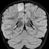 Coronal FLAIR MR shows a cortically based, triangular mass that is well circumscribed . There is no contrast enhancement (not shown). Dysembryoplastic neuroepithelial tumors are typically cortically based, low-grade tumors that can have a cystic appearance.