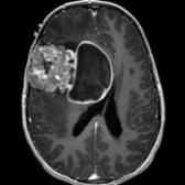 Axial T1 C+ MR shows a large,  heterogeneous mass  with a solid periphery involving the cortex and central cyst. There is resulting subfalcine herniation. Although rare, "bubbly," solid peripheral tumors with a cyst are the typical appearance for astroblastomas.
