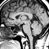 Sagittal T1 MR in a 59-year-old woman with blurry vision and a primary hypopituitarism shows an enlarged, mostly CSF-filled sella turcica . The pituitary gland appears flattened along the sellar floor and a posterior pituitary "bright spot" is absent.