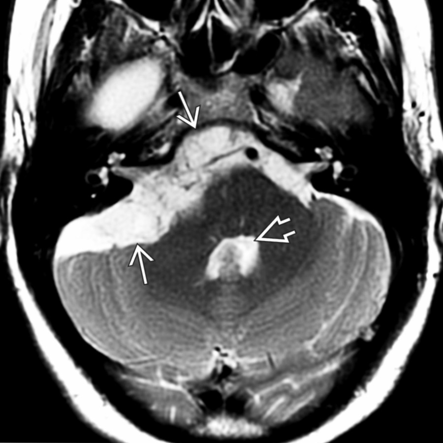 Axial T2 MR in the same patient shows the mass  is nearly as hyperintense as fluid in the CPA cistern and 4th ventricle .