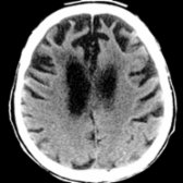 Axial NECT in a 78-year-old patient diagnosed with late-stage FTD through the upper lateral ventricles shows striking frontal lobar atrophy with classic knife-like gyri  characteristic of FTD. In contrast, the parietal & occipital lobes appear relatively spared.
